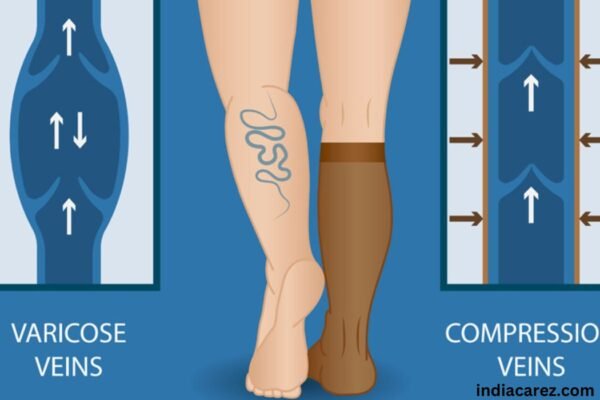 Managing Varicose Veins