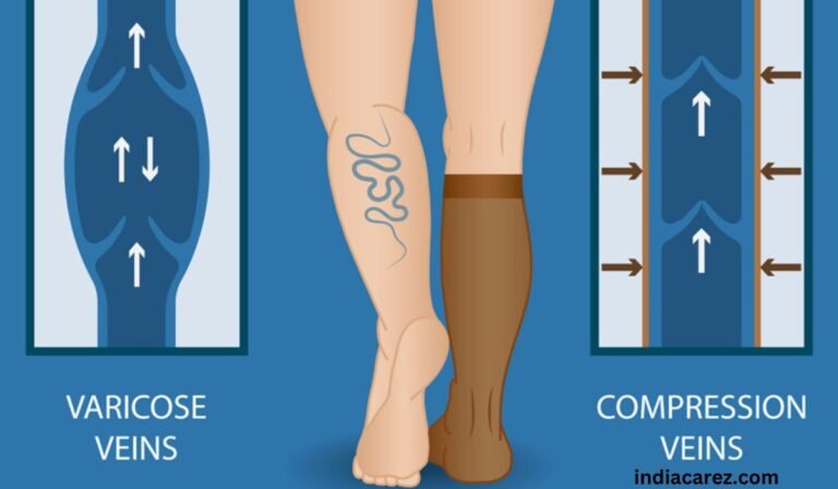 Managing Varicose Veins