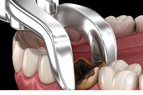 Removing Wisdom Teeth