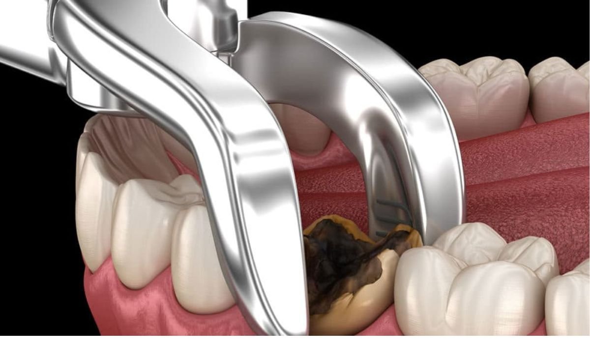 Removing Wisdom Teeth